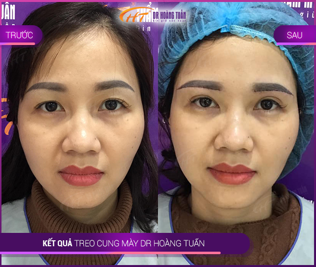 Kết quả sửa chân mày tại Thẩm mỹ Hoàng Tuấn